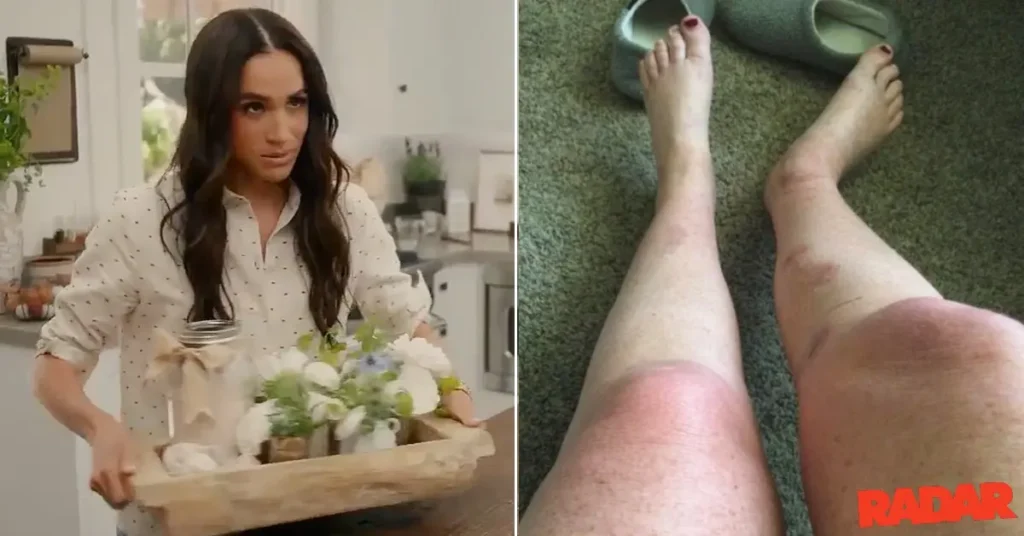 meghan markle fan launches 10million lawsuit catastrophic burns duchess homemade bath salt recipe pp1 1746114875513