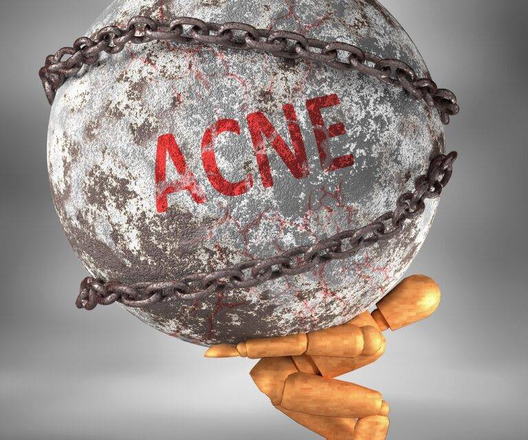 acne, life, demolish, symbolism, wrecking ball, destruction, smash, word, bad, effect, negative, destroy, wreck, misery, sad, unwanted, burden, danger, design, symbol, stigma, 3d, poster, acne, acne, acne, acne, acne, burden